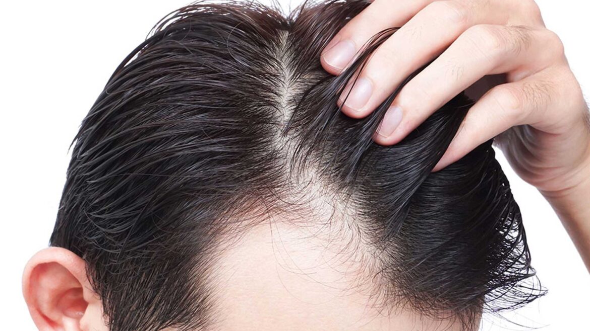 زراعة الشعر المهدئ